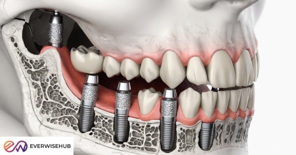 best full mouth dental implants